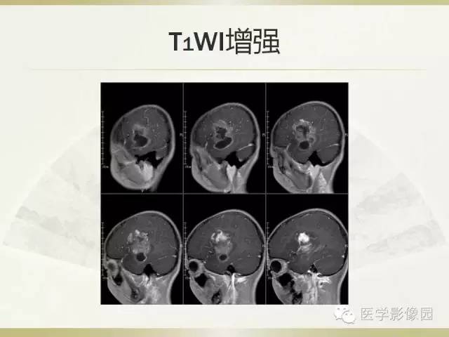 【病例】右颞叶多形性黄色星形细胞瘤1例MR影像表现