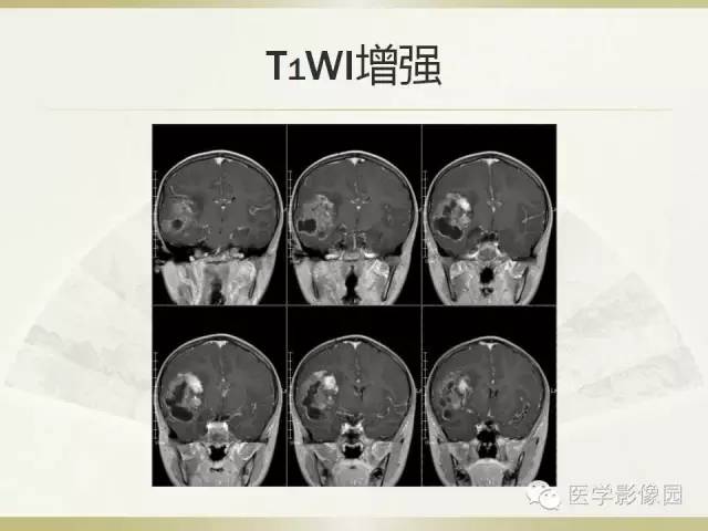 【病例】右颞叶多形性黄色星形细胞瘤1例MR影像表现