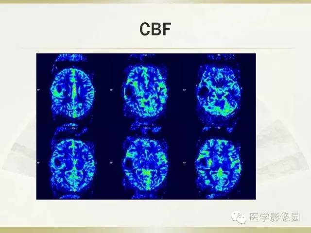 【病例】右颞叶多形性黄色星形细胞瘤1例MR影像表现