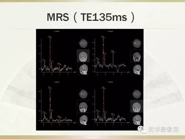 【病例】右颞叶多形性黄色星形细胞瘤1例MR影像表现