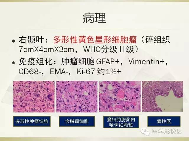 【病例】右颞叶多形性黄色星形细胞瘤1例MR影像表现