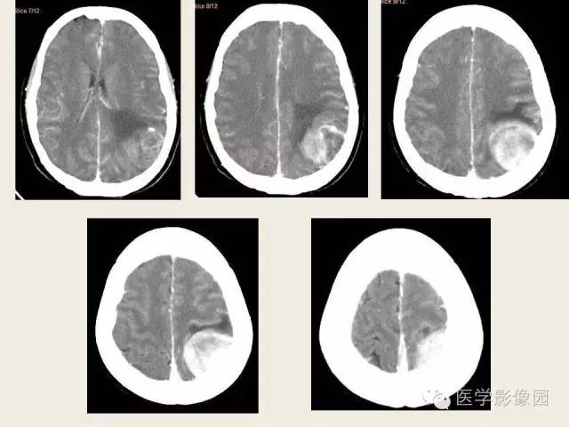 【病例】颅内孤立性纤维性瘤1例CT及MR影像表现