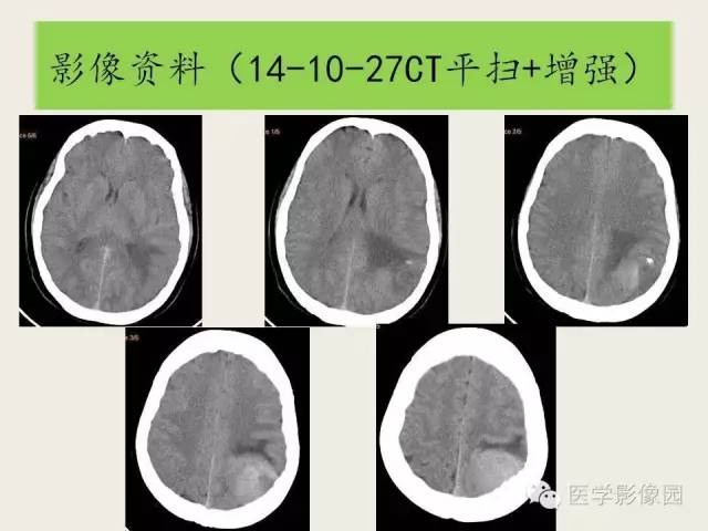 【病例】颅内孤立性纤维性瘤1例CT及MR影像表现