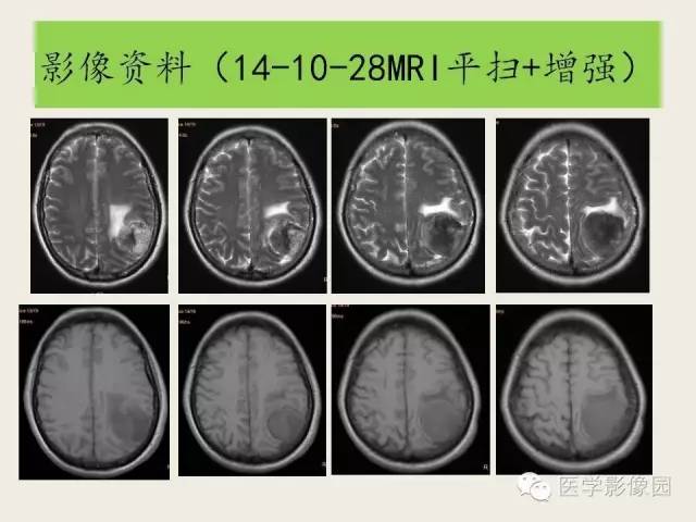 【病例】颅内孤立性纤维性瘤1例CT及MR影像表现
