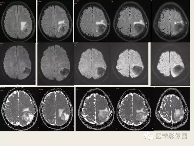 【病例】颅内孤立性纤维性瘤1例CT及MR影像表现
