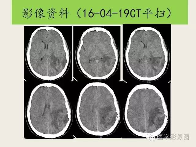 【病例】颅内孤立性纤维性瘤1例CT及MR影像表现