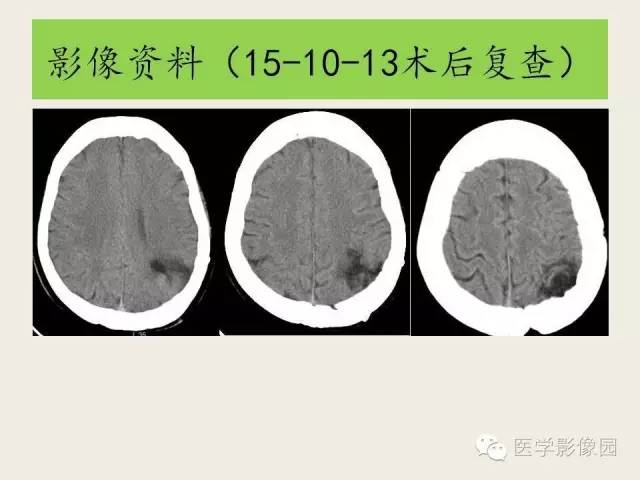 【病例】颅内孤立性纤维性瘤1例CT及MR影像表现