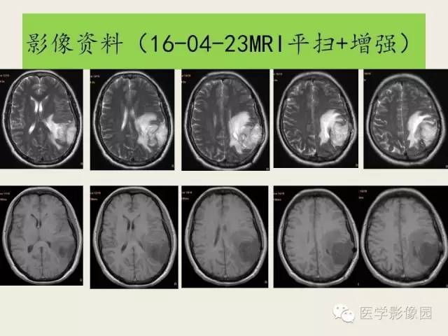 【病例】颅内孤立性纤维性瘤1例CT及MR影像表现