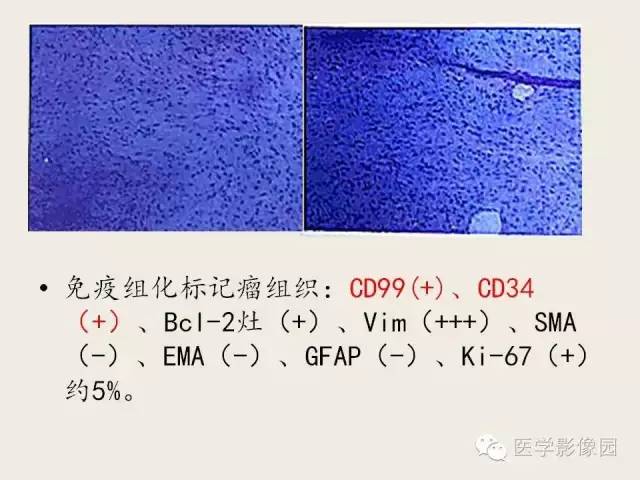 【病例】颅内孤立性纤维性瘤1例CT及MR影像表现