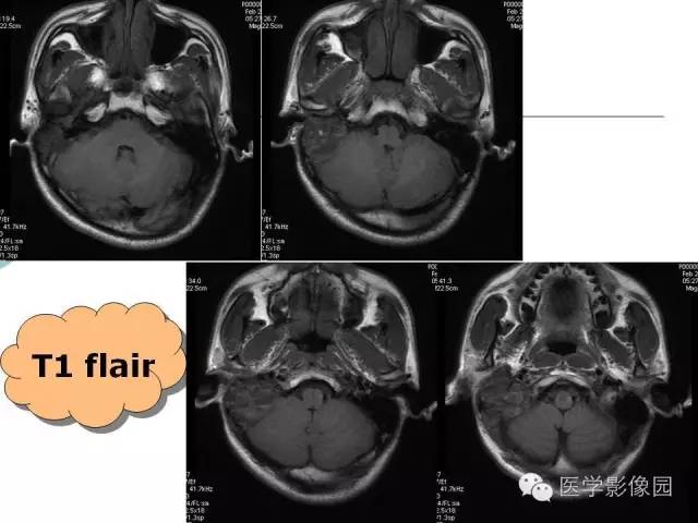 【病例】颞骨动脉瘤样骨囊肿1例CT及MR影像表现