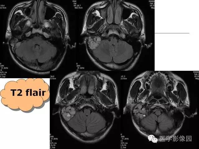 【病例】颞骨动脉瘤样骨囊肿1例CT及MR影像表现