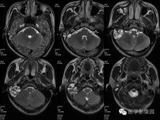 【病例】颞骨动脉瘤样骨囊肿1例CT及MR影像表现