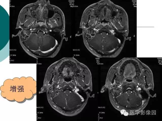 【病例】颞骨动脉瘤样骨囊肿1例CT及MR影像表现