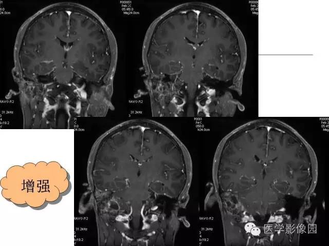【病例】颞骨动脉瘤样骨囊肿1例CT及MR影像表现