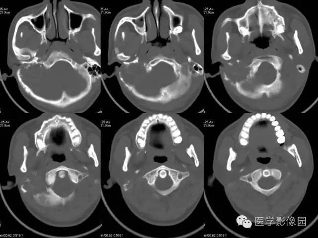 【病例】颞骨动脉瘤样骨囊肿1例CT及MR影像表现