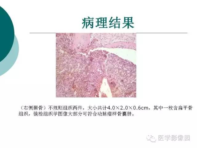 【病例】颞骨动脉瘤样骨囊肿1例CT及MR影像表现