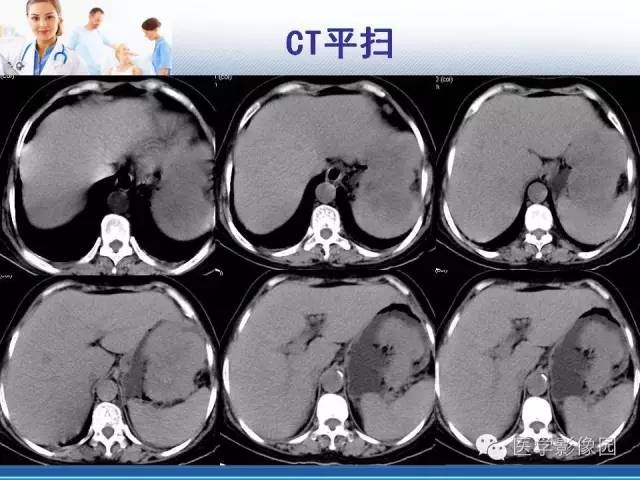 【病例】胃大弯占位？——脾脏血管肉瘤1例CT影像表现