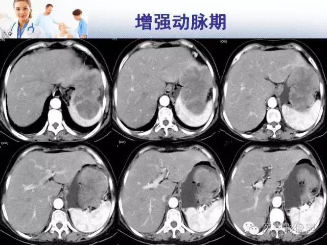 【病例】胃大弯占位？——脾脏血管肉瘤1例CT影像表现