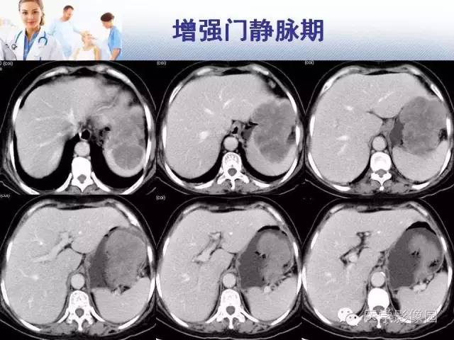 【病例】胃大弯占位？——脾脏血管肉瘤1例CT影像表现