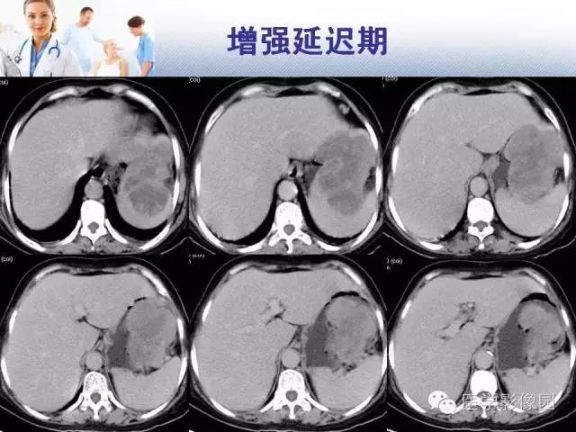 【病例】胃大弯占位？——脾脏血管肉瘤1例CT影像表现