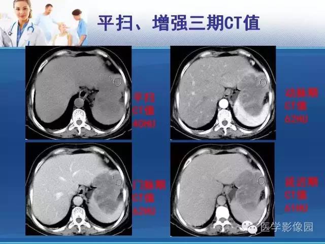 【病例】胃大弯占位？——脾脏血管肉瘤1例CT影像表现