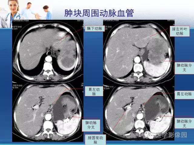 【病例】胃大弯占位？——脾脏血管肉瘤1例CT影像表现