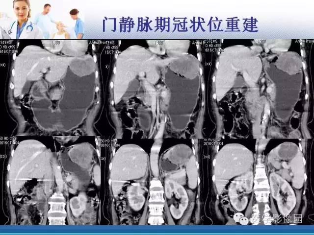 【病例】胃大弯占位？——脾脏血管肉瘤1例CT影像表现