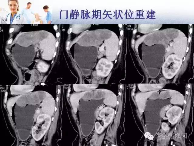 【病例】胃大弯占位？——脾脏血管肉瘤1例CT影像表现