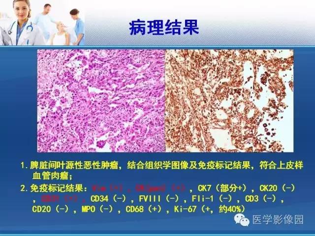 【病例】胃大弯占位？——脾脏血管肉瘤1例CT影像表现