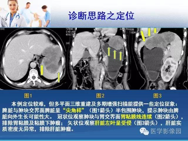 【病例】胃大弯占位？——脾脏血管肉瘤1例CT影像表现