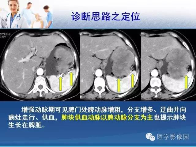 【病例】胃大弯占位？——脾脏血管肉瘤1例CT影像表现