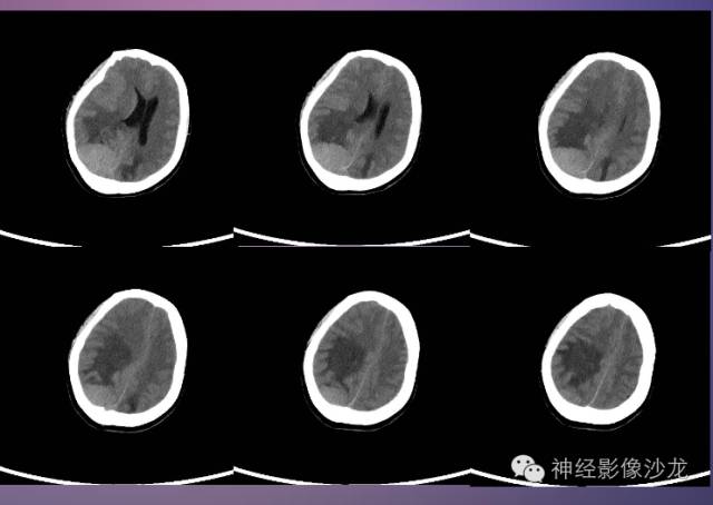 【病例】脑膜瘤1例CT及MR影像表现 【病例】脑膜瘤1例CT及MR影像表现