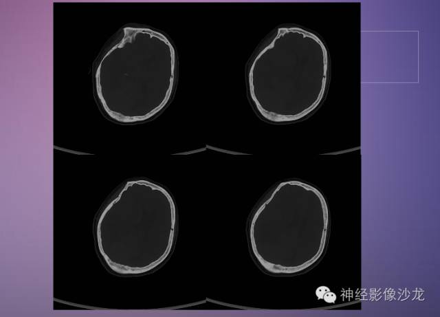 【病例】脑膜瘤1例CT及MR影像表现 【病例】脑膜瘤1例CT及MR影像表现