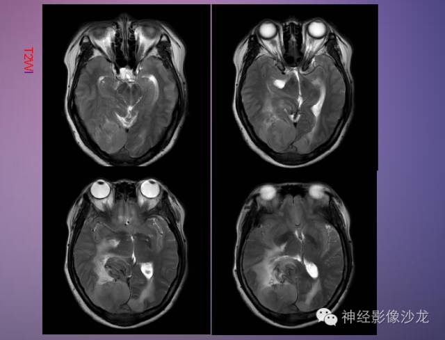 【病例】脑膜瘤1例CT及MR影像表现 【病例】脑膜瘤1例CT及MR影像表现