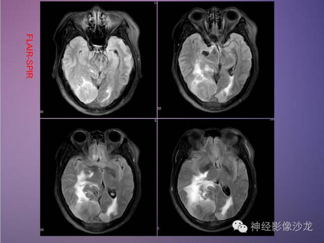 【病例】脑膜瘤1例CT及MR影像表现 【病例】脑膜瘤1例CT及MR影像表现