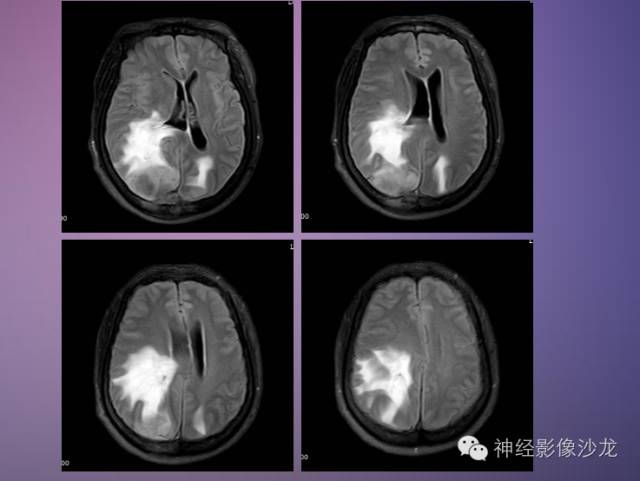 【病例】脑膜瘤1例CT及MR影像表现 【病例】脑膜瘤1例CT及MR影像表现