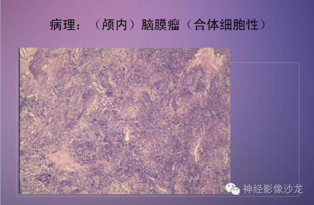 【病例】脑膜瘤1例CT及MR影像表现 【病例】脑膜瘤1例CT及MR影像表现