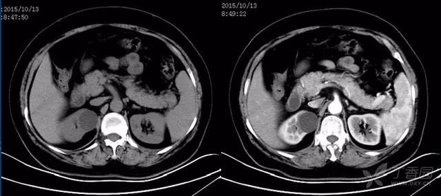 5分钟轻松学：肾脏囊性病变CT 表现