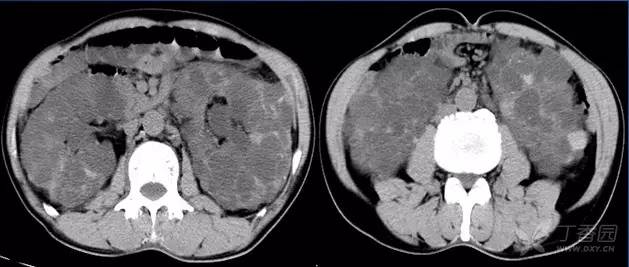 5分钟轻松学:肾脏囊性病变CT 表现 5分钟轻松学:肾脏囊性病变CT 表现