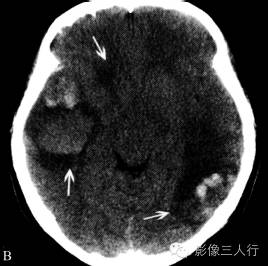 静脉性脑梗死与动脉性脑梗死的鉴别要点