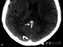静脉性脑梗死与动脉性脑梗死的鉴别要点 静脉性脑梗死与动脉性脑梗死的鉴别要点