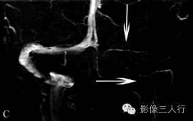 静脉性脑梗死与动脉性脑梗死的鉴别要点 静脉性脑梗死与动脉性脑梗死的鉴别要点
