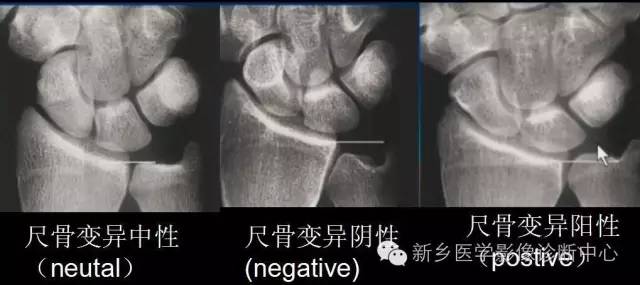 三角纤维软骨复合体损伤 三角纤维软骨复合体损伤