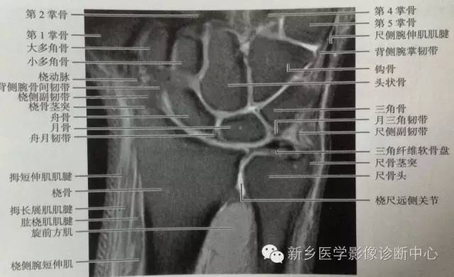 三角纤维软骨复合体损伤 三角纤维软骨复合体损伤