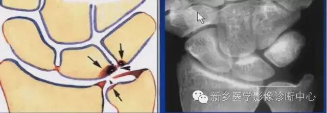 三角纤维软骨复合体损伤 三角纤维软骨复合体损伤