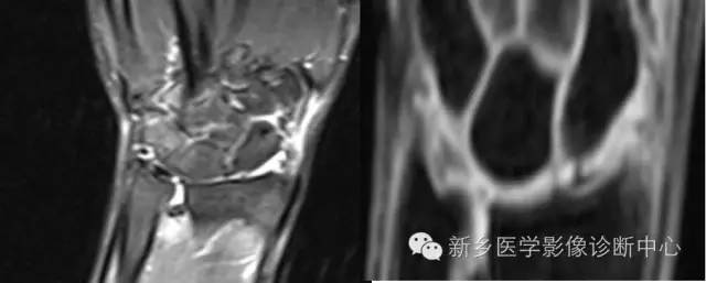 三角纤维软骨复合体损伤 三角纤维软骨复合体损伤