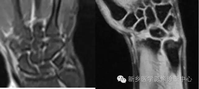 三角纤维软骨复合体损伤 三角纤维软骨复合体损伤