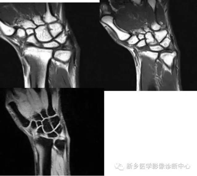 三角纤维软骨复合体损伤 三角纤维软骨复合体损伤