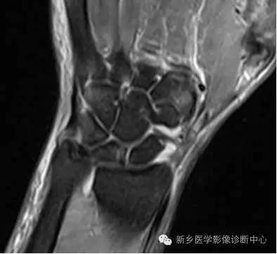 三角纤维软骨复合体损伤 三角纤维软骨复合体损伤