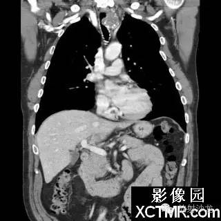 【双语病例】原发性气管软管肉瘤1例 【双语病例】原发性气管软管肉瘤1例